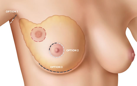 A 32-year-old woman with right breast scar from surgery of cyst removal